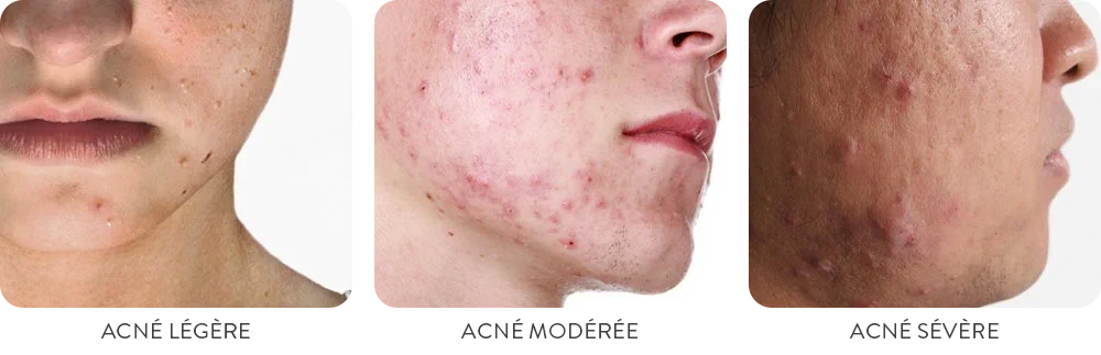 différents types d'acné